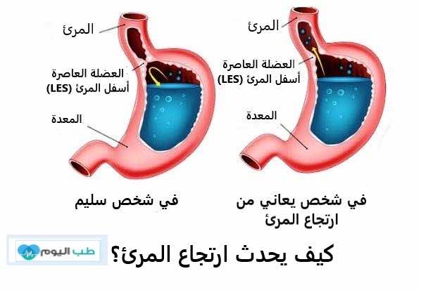 علاج ارتجاع المريء عند الرضع بالاعشاب , الاطفال لازم نتعرف على علاجهم