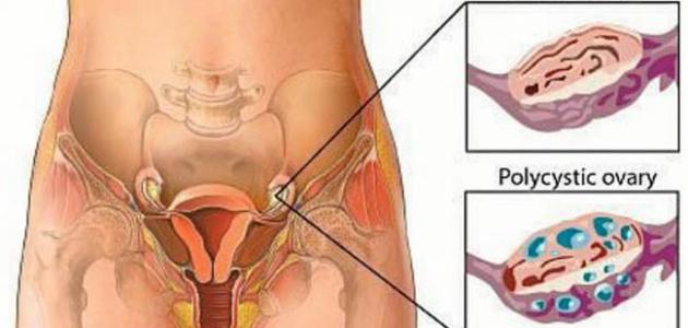 ماهو علاج تكيس المبايض- كيف يتم علاج تكيس المبايض ماهو علاج تكيس المبايض كيف يتم علاج تكي