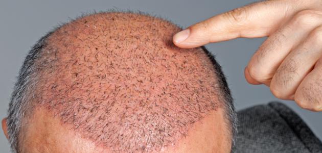 معلومات عن زراعة الشعر ، ادق واهم المعلومات عن زراعة الشعر ما هي زراعة الشعر