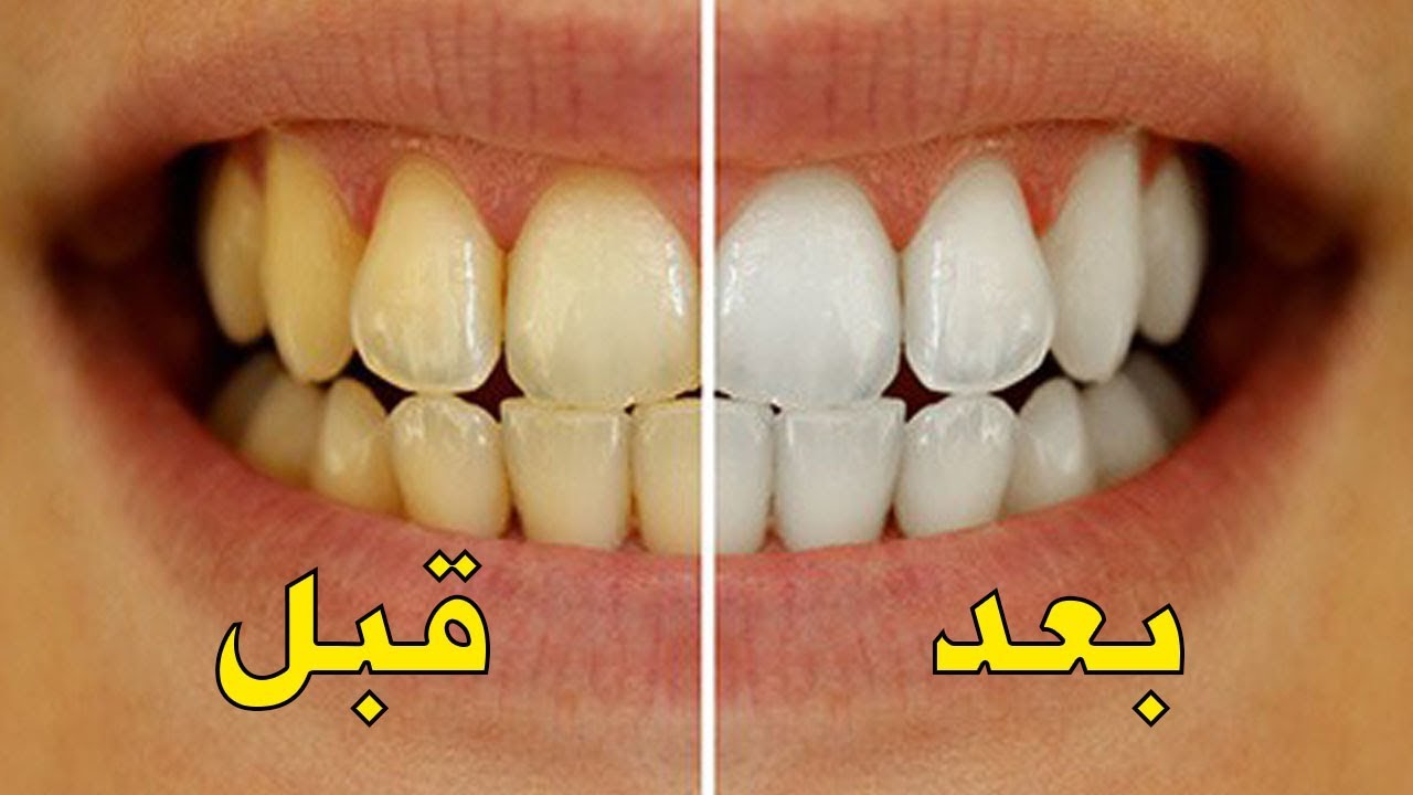 طريقة تبييض الاسنان , احصلي علي اسنان مثل الماس