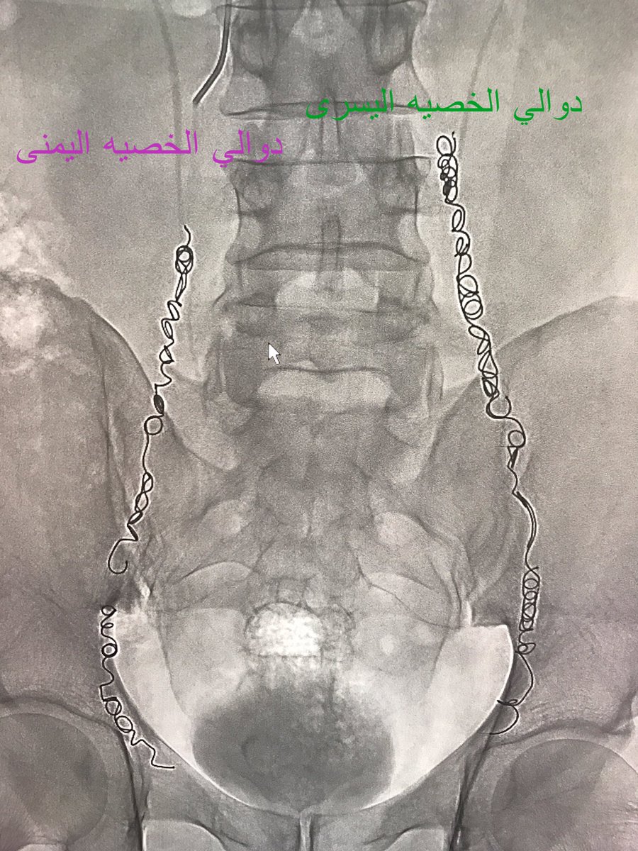 عملية دوالي الخصية بالصور- شكوى الرجال كتير -D8-B9-D9-85-D9-84-D9-8A-D8-A9 -D8-Af-D9-88-D8-A7-D9-84-D9-8A -D8-A7-D9-84-D8-Ae-D8-B5-D9-8A-D8-A9 -D8-A8-D8-A7-D9-84-D8-B5-D9-88-D8-B1 -D8-B4-D9-83-D9-88-D9-89 -D8-A7-D9-84-D8-B1-D8-Ac-D8-A7-D9-84 5