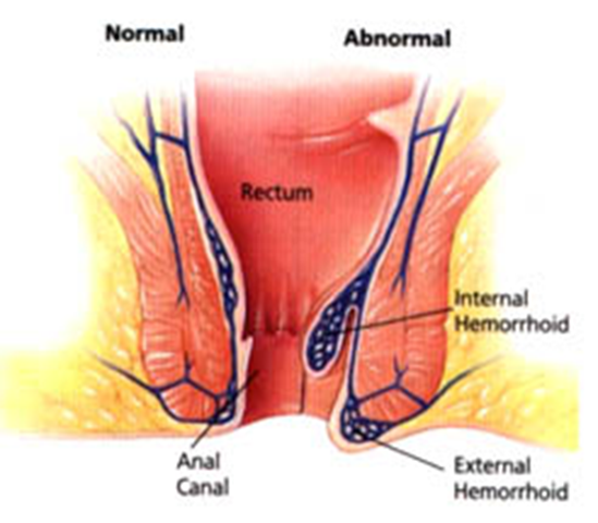 البواسير بالصور الحقيقية - الفرق بين البواسير الداخليه والخارجيه البواسير بالصور الحقيقية الفرق بين ال