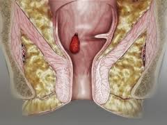 اعراض البواسير عند الرجال , تعرف على اعراض البواسير