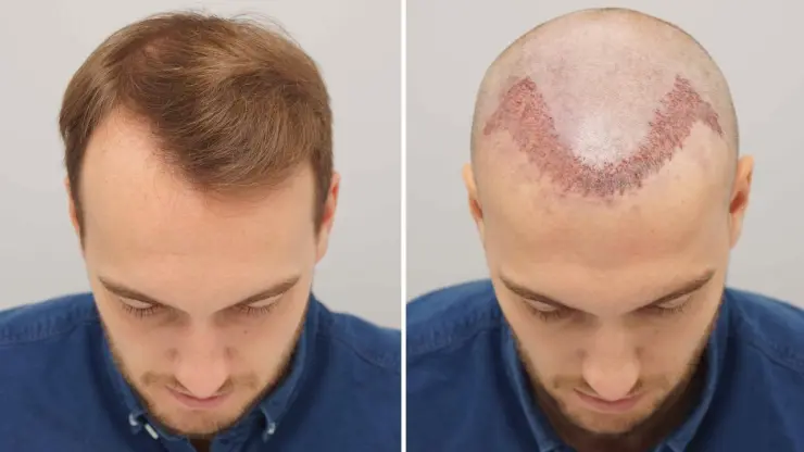 افضل مكان لزراعة الشعر في العالم , زرع الشعر بطريقه امنه