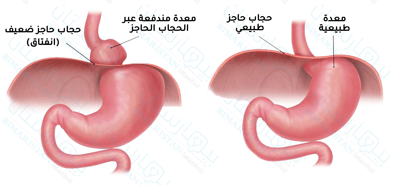 هل عملية فتق الحجاب الحاجز خطيرة - اضرار واسباب عملية الفتق -D9-87-D9-84 -D8-B9-D9-85-D9-84-D9-8A-D8-A9 -D9-81-D8-Aa-D9-82 -D8-A7-D9-84-D8-Ad-D8-Ac-D8-A7-D8-A8 -D8-A7-D9-84-D8-Ad-D8-A7-D8-Ac-D8-B2 -D8-Ae-D8-B7-D9-8A-D8-B1-D8-A9 -D8-A7-D8-B6-D8-B1-D8-A7-D8-B1