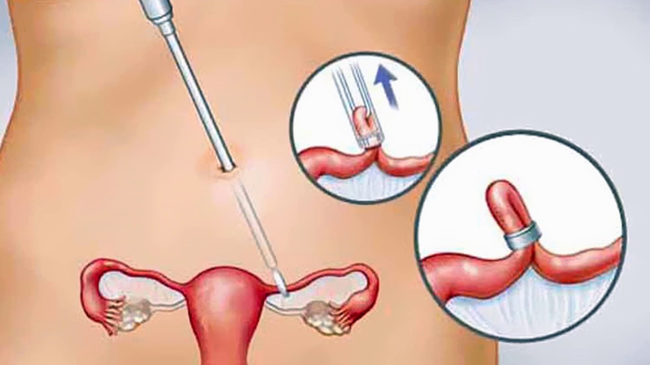 عملية ربط الرحم لمنع الحمل - امنعي الحمل بكل سهولة -D8-B9-D9-85-D9-84-D9-8A-D8-A9 -D8-B1-D8-A8-D8-B7 -D8-A7-D9-84-D8-B1-D8-Ad-D9-85 -D9-84-D9-85-D9-86-D8-B9 -D8-A7-D9-84-D8-Ad-D9-85-D9-84 -D8-A7-D9-85-D9-86-D8-B9-D9-8A -D8-A7-D9-84-D8-Ad-D9-85-D9-84 1