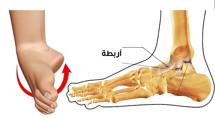 علاج تمزق الاربطة في الكاحل- الحل السريع علاج تمزق الاربطة في الكاحل الحل السري