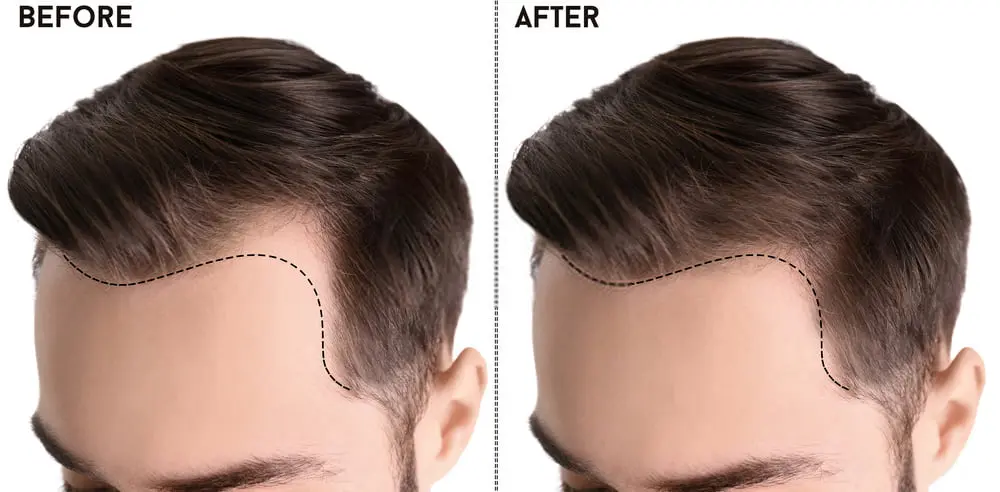 سعر زراعة الشعر في تركيا , كم تكلف عملية زرع الشعر في تركيا