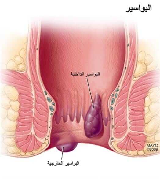 البواسير بالصور الحقيقية - الفرق بين البواسير الداخليه والخارجيه -D8-A7-D9-84-D8-A8-D9-88-D8-A7-D8-B3-D9-8A-D8-B1 -D8-A8-D8-A7-D9-84-D8-B5-D9-88-D8-B1 -D8-A7-D9-84-D8-Ad-D9-82-D9-8A-D9-82-D9-8A-D8-A9 -D8-A7-D9-84-D9-81-D8-B1-D9-82 -D8-A8-D9-8A-D9-86 -D8-A7-D9-84 1