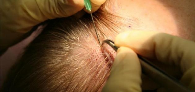 أفضل طريقة لزراعة الشعر , أحداث التقنيات التطور للشعر