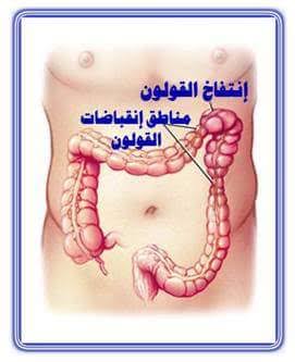 شكل القولون المنتفخ , اسباب انتفاخ القولون العصبي