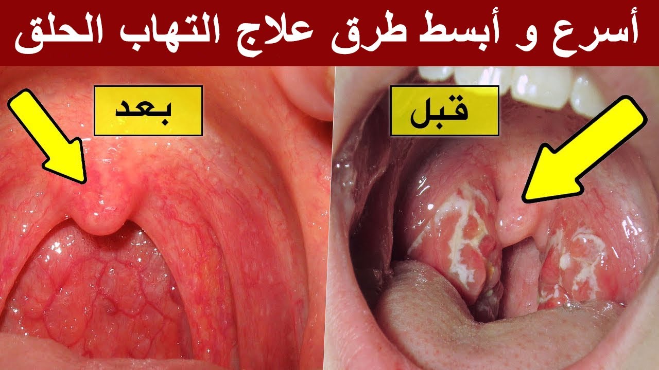 علاج حرقة البلعوم بالاعشاب , افضل الاعشاب وارخصها