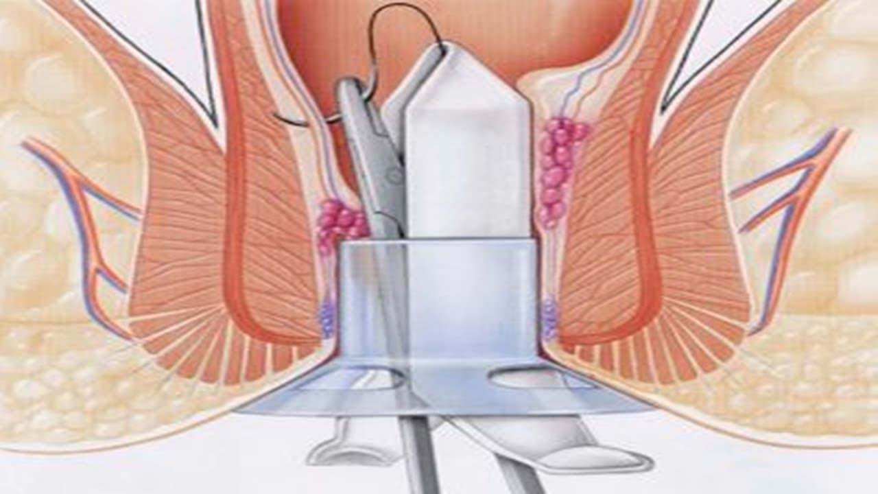 تجربتي عملية البواسير , هل هذه العمليه تنجح ام لا