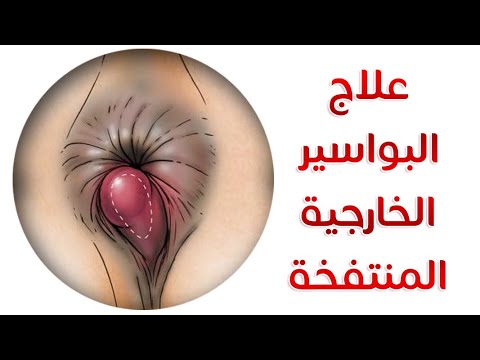 البواسير بالصور الحقيقية - الفرق بين البواسير الداخليه والخارجيه -D8-A7-D9-84-D8-A8-D9-88-D8-A7-D8-B3-D9-8A-D8-B1 -D8-A8-D8-A7-D9-84-D8-B5-D9-88-D8-B1 -D8-A7-D9-84-D8-Ad-D9-82-D9-8A-D9-82-D9-8A-D8-A9 -D8-A7-D9-84-D9-81-D8-B1-D9-82 -D8-A8-D9-8A-D9-86 -D8-A7-D9-84 4