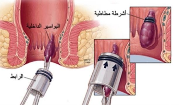 البواسير بالصور الحقيقية - الفرق بين البواسير الداخليه والخارجيه -D8-A7-D9-84-D8-A8-D9-88-D8-A7-D8-B3-D9-8A-D8-B1 -D8-A8-D8-A7-D9-84-D8-B5-D9-88-D8-B1 -D8-A7-D9-84-D8-Ad-D9-82-D9-8A-D9-82-D9-8A-D8-A9 -D8-A7-D9-84-D9-81-D8-B1-D9-82 -D8-A8-D9-8A-D9-86 -D8-A7-D9-84