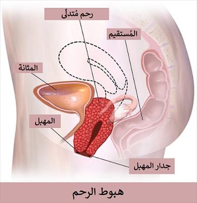 معلومات عن نزول الرحم , تعرف الى نزول الرحم