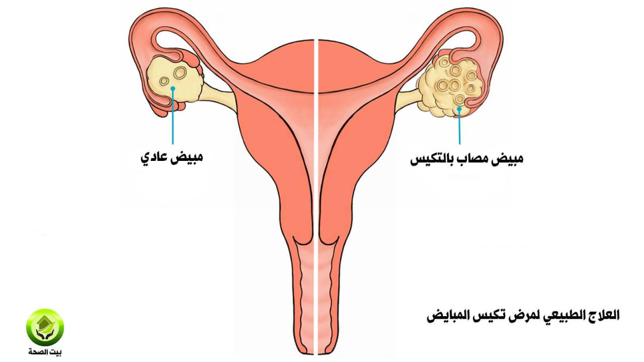 كيف اعرف ان عندي تكيس- له علاج متخفيش كيف اعرف ان عندي تكيس له علاج متخفيش