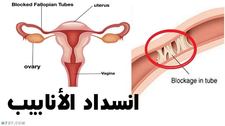 بذور الخردل لعلاج الالتصاقات وانسداد الانابيب - ما هو علاج انسداد الانابيب Images 8 6