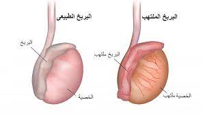 الام في الخصيتين , مين بيعرف سببه