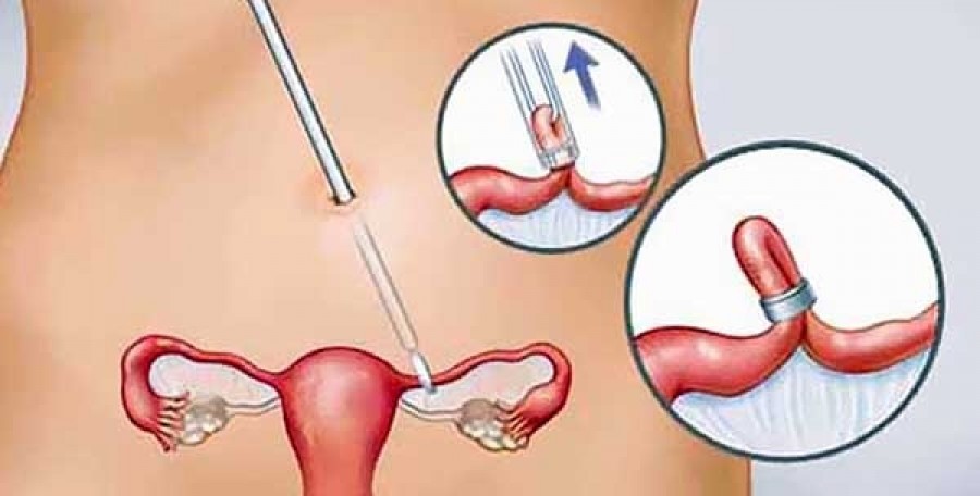 ربط الرحم لمنع الحمل المؤقت - عملیة ربط عنق الرحم ربط الرحم لمنع الحمل المؤقت عملیة ربط