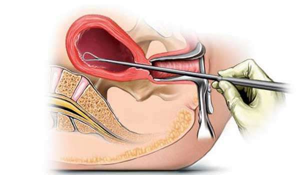 عملية تنظيف الرحم - مخاطر هذه عمليه تنظيف الرحم عملية تنظيف الرحم مخاطر هذه عمليه تنظي