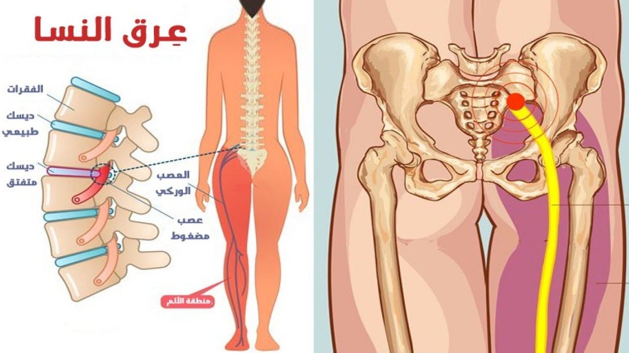 دعاء لعلاج عرق النسا - اعظم الادعية للشفاء باذن الله -D8-Af-D8-B9-D8-A7-D8-A1 -D9-84-D8-B9-D9-84-D8-A7-D8-Ac -D8-B9-D8-B1-D9-82 -D8-A7-D9-84-D9-86-D8-B3-D8-A7 -D8-A7-D8-B9-D8-B8-D9-85 -D8-A7-D9-84-D8-A7-D8-Af-D8-B9-D9-8A-D8-A9 -D9-84-D9-84-D8-B4-D9-81 2