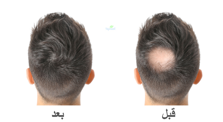 زراعة الشعر في الجزائر , هل تعلموا عن كيفية التعاملات فى زراعة الشعر