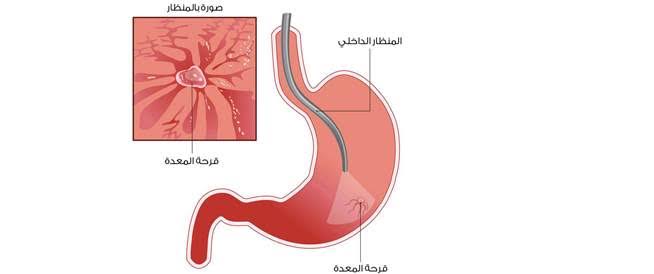 علاج قرحة المعدة- كيفية علاج قرحة المعدة Images