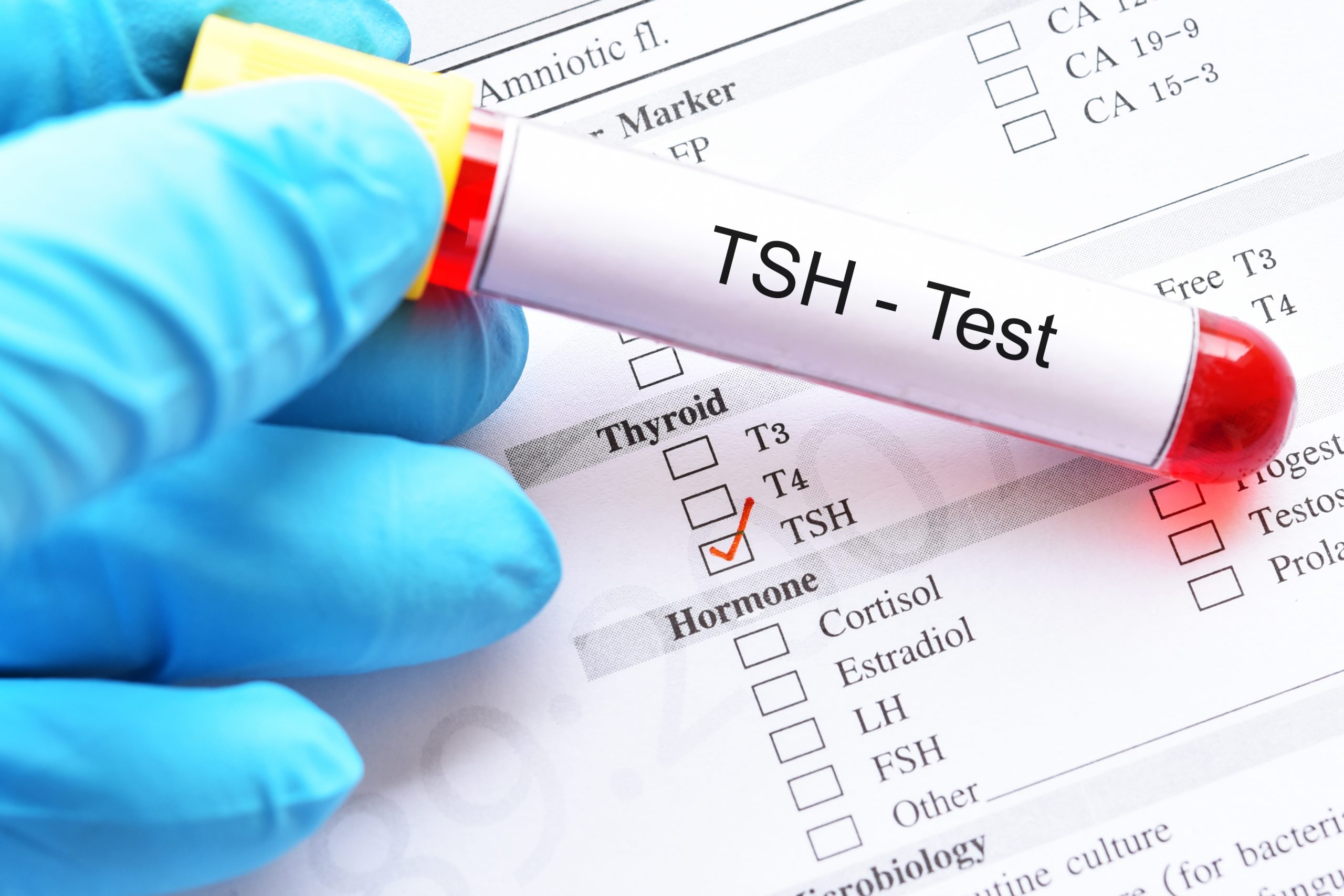 هل ارتفاع هرمون Tsh يمنع الحمل 26 Tsh Misleading Scaled 1