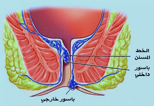 البواسير بالصور الحقيقية - الفرق بين البواسير الداخليه والخارجيه -D8-A7-D9-84-D8-A8-D9-88-D8-A7-D8-B3-D9-8A-D8-B1 -D8-A8-D8-A7-D9-84-D8-B5-D9-88-D8-B1 -D8-A7-D9-84-D8-Ad-D9-82-D9-8A-D9-82-D9-8A-D8-A9 -D8-A7-D9-84-D9-81-D8-B1-D9-82 -D8-A8-D9-8A-D9-86 -D8-A7-D9-84 5