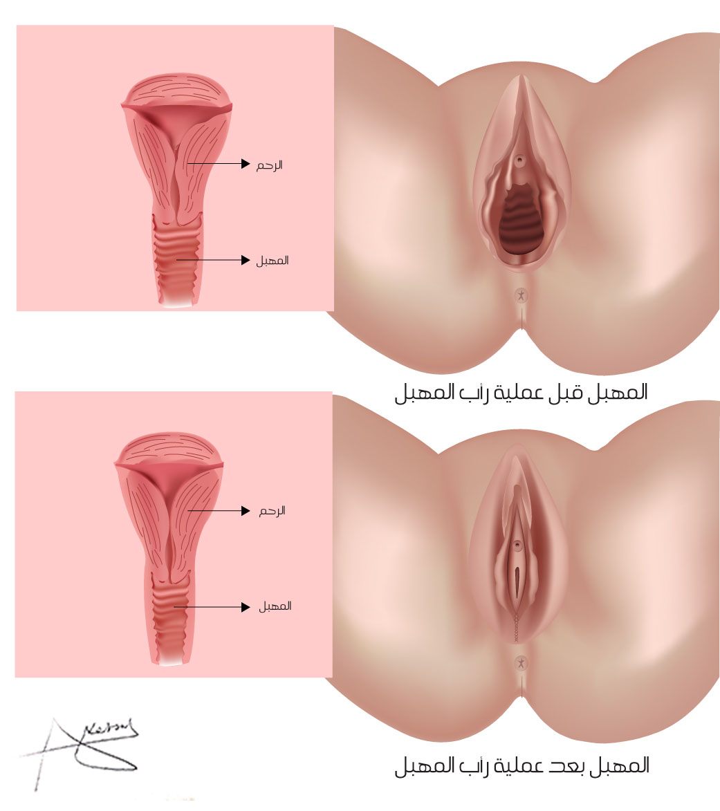 تضييق المهبل بالصور - بكل الطرق هتحصلي على مهبل ضيق -D8-Aa-D8-B6-D9-8A-D9-8A-D9-82 -D8-A7-D9-84-D9-85-D9-87-D8-A8-D9-84 -D8-A8-D8-A7-D9-84-D8-B5-D9-88-D8-B1 -D8-A8-D9-83-D9-84 -D8-A7-D9-84-D8-B7-D8-B1-D9-82 -D9-87-D8-Aa-D8-Ad-D8-B5-D9-84-D9-8A -D8-B9