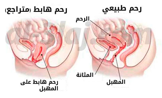 عملية هبوط الرحم , ما هى عملية رفع الرحم