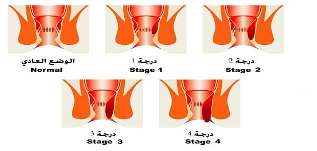 البواسير بالصور الحقيقية - الفرق بين البواسير الداخليه والخارجيه -D8-A7-D9-84-D8-A8-D9-88-D8-A7-D8-B3-D9-8A-D8-B1 -D8-A8-D8-A7-D9-84-D8-B5-D9-88-D8-B1 -D8-A7-D9-84-D8-Ad-D9-82-D9-8A-D9-82-D9-8A-D8-A9 -D8-A7-D9-84-D9-81-D8-B1-D9-82 -D8-A8-D9-8A-D9-86 -D8-A7-D9-84 6