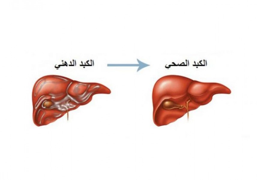 اذا واجهتوا لوعه الكبد والحموضه- علاج لوعة الكبد اذا واجهتوا لوعه الكبد والحموضه علاج ل