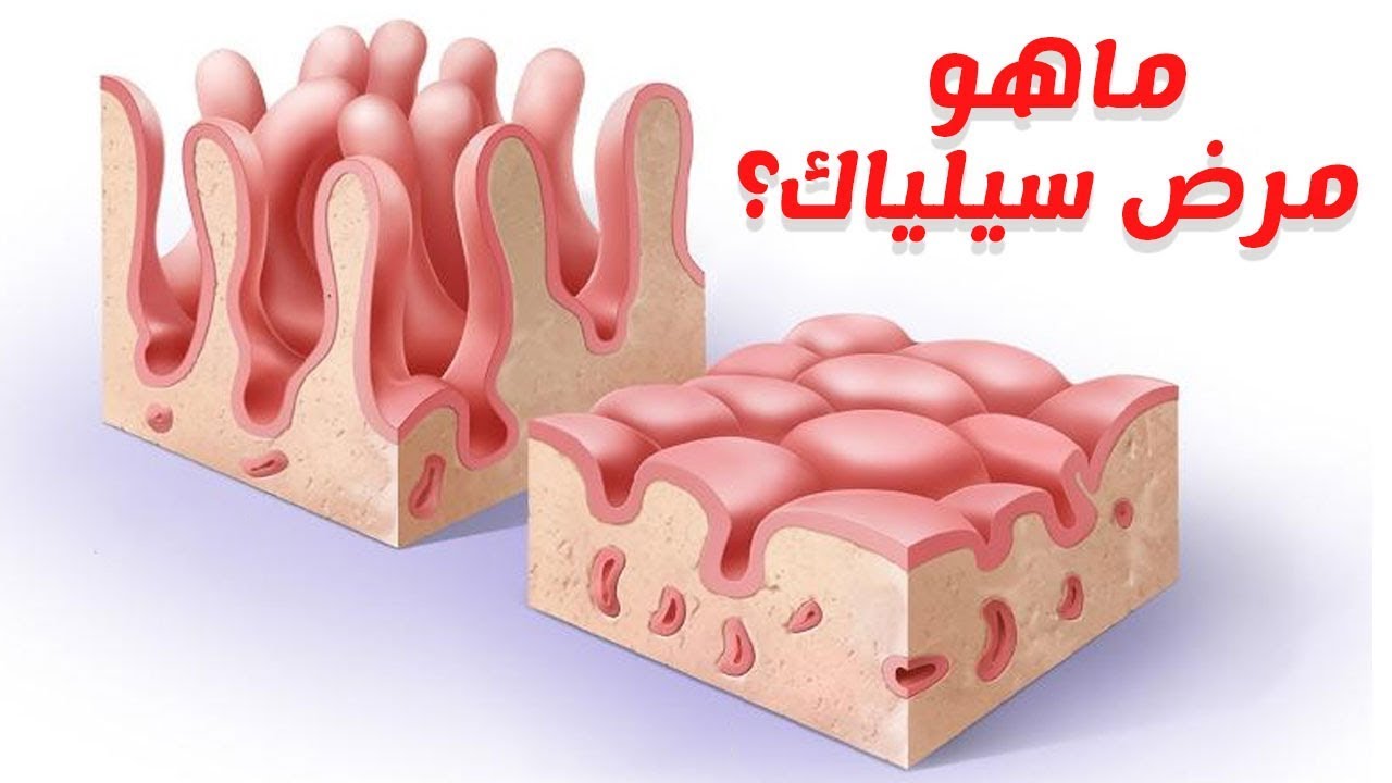 اعراض مرض السيلياك من اشد انواع المرض