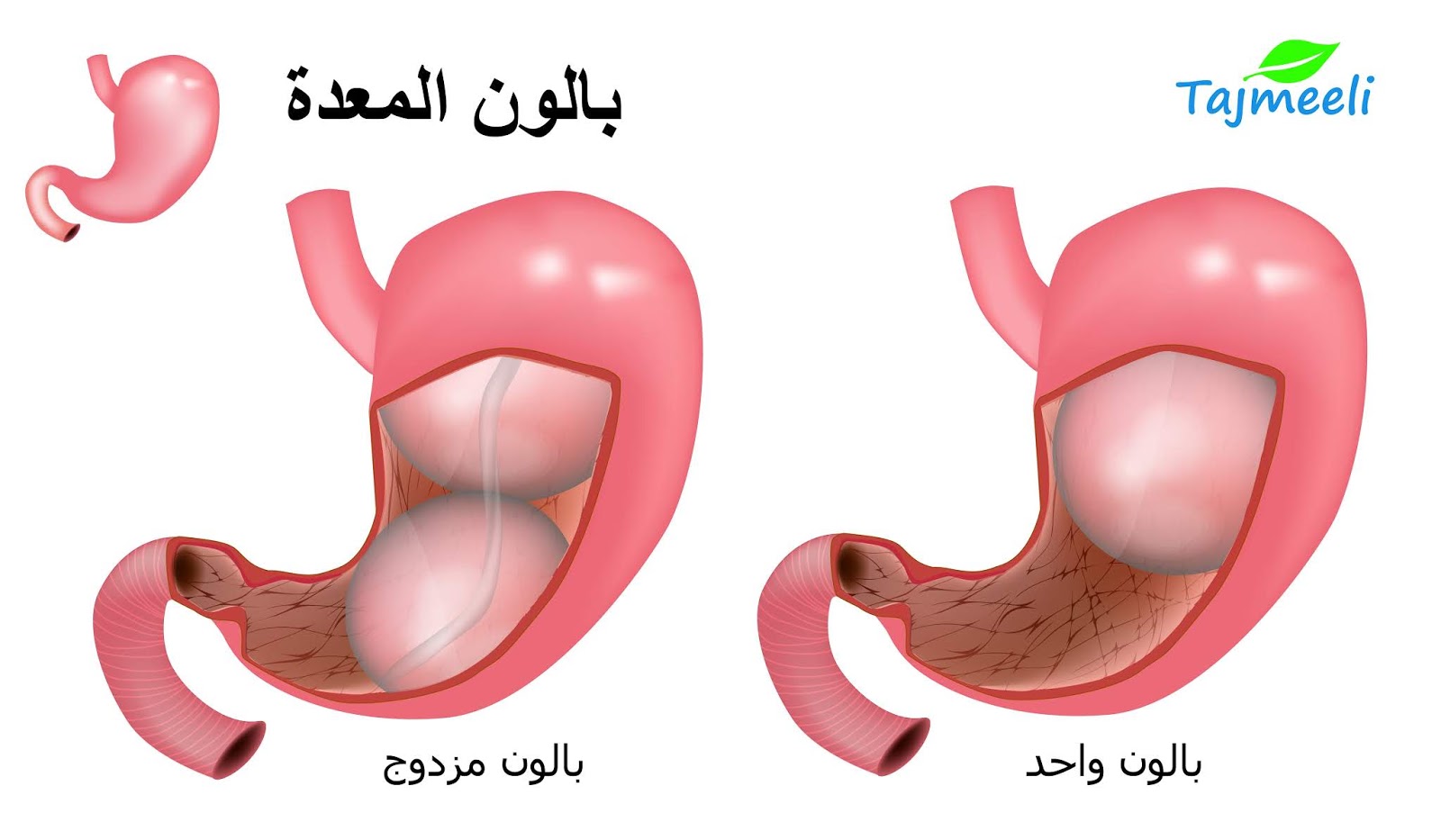 اسعار بالون المعدة - تكلفة بالون المعدة اسعار بالون المعدة تكلفة بالون المعدة