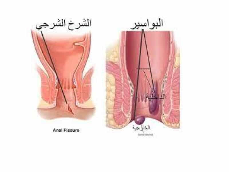 تجربتى مع الشرخ الشرجى , ما هو الشرخ الشرجى