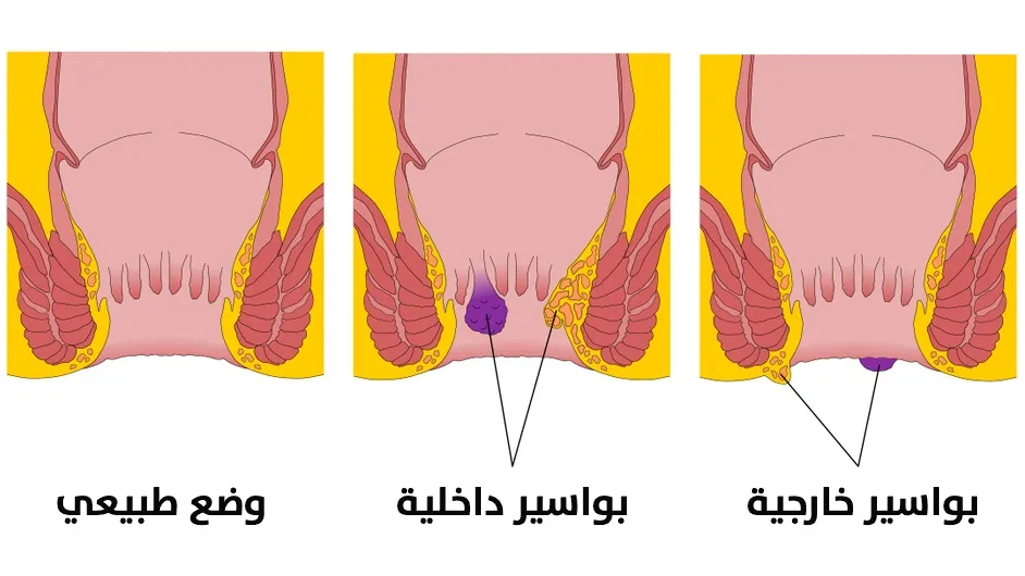 البواسير بالصور الحقيقية - الفرق بين البواسير الداخليه والخارجيه -D8-A7-D9-84-D8-A8-D9-88-D8-A7-D8-B3-D9-8A-D8-B1 -D8-A8-D8-A7-D9-84-D8-B5-D9-88-D8-B1 -D8-A7-D9-84-D8-Ad-D9-82-D9-8A-D9-82-D9-8A-D8-A9 -D8-A7-D9-84-D9-81-D8-B1-D9-82 -D8-A8-D9-8A-D9-86 -D8-A7-D9-84 8