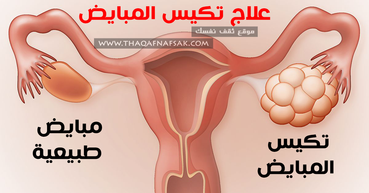 بنات الله يخليكم مين تعرف وصفة بالاعشاب مضمونه لازالة الكيس من المبيض احتاج لفزعتكم , علاج تكيس المبايض بالأعشاب