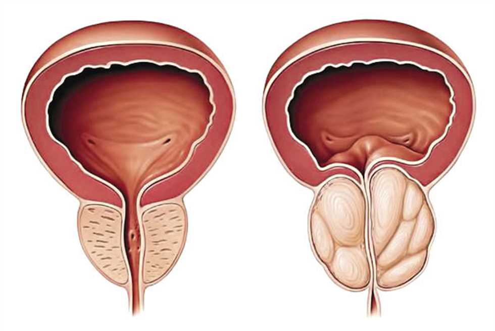 ما هو مرض البروستات , معلومات عن امراض الجهاز التناسلي