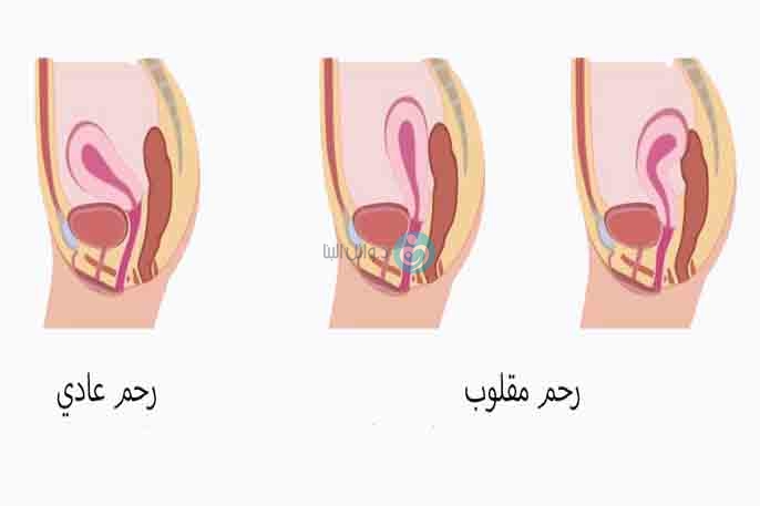 الرحم المقلوب بالصور - الاسباب المؤديه لهذه الحاله -D8-A7-D9-84-D8-B1-D8-Ad-D9-85 -D8-A7-D9-84-D9-85-D9-82-D9-84-D9-88-D8-A8 -D8-A8-D8-A7-D9-84-D8-B5-D9-88-D8-B1 -D8-A7-D9-84-D8-A7-D8-B3-D8-A8-D8-A7-D8-A8 -D8-A7-D9-84-D9-85-D8-A4-D8-Af-D9-8A-D9-87 2