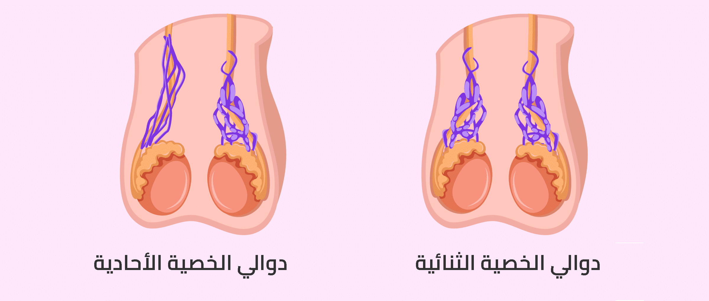 عملية دوالي الخصية بالصور- شكوى الرجال كتير -D8-B9-D9-85-D9-84-D9-8A-D8-A9 -D8-Af-D9-88-D8-A7-D9-84-D9-8A -D8-A7-D9-84-D8-Ae-D8-B5-D9-8A-D8-A9 -D8-A8-D8-A7-D9-84-D8-B5-D9-88-D8-B1 -D8-B4-D9-83-D9-88-D9-89 -D8-A7-D9-84-D8-B1-D8-Ac-D8-A7-D9-84 3