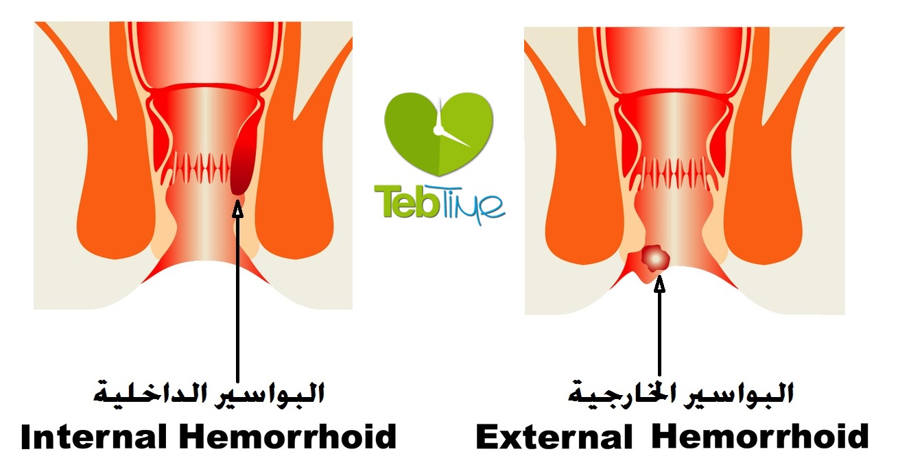 البواسير بالصور الحقيقية - الفرق بين البواسير الداخليه والخارجيه -D8-A7-D9-84-D8-A8-D9-88-D8-A7-D8-B3-D9-8A-D8-B1 -D8-A8-D8-A7-D9-84-D8-B5-D9-88-D8-B1 -D8-A7-D9-84-D8-Ad-D9-82-D9-8A-D9-82-D9-8A-D8-A9 -D8-A7-D9-84-D9-81-D8-B1-D9-82 -D8-A8-D9-8A-D9-86 -D8-A7-D9-84 7