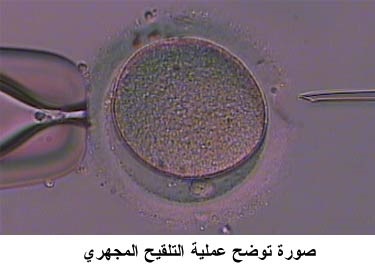 للمقدمات على التلقيح المجهري اطفال الانابيب - نبذه عن التلقيح الصناعى و اطفال الانابيب -D9-84-D9-84-D9-85-D9-82-D8-Af-D9-85-D8-A7-D8-Aa -D8-B9-D9-84-D9-89 -D8-A7-D9-84-D8-Aa-D9-84-D9-82-D9-8A-D8-Ad -D8-A7-D9-84-D9-85-D8-Ac-D9-87-D8-B1-D9-8A -D8-A7-D8-B7-D9-81-D8-A7-D9-84 -D8-A7-D9-84