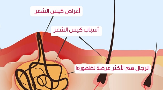 علاج الناسور العصعصي في بدايته , تخلص من الم المزعجة