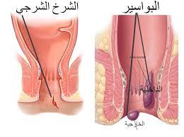 اخيرا انتهت معاناتي من الشرخ والبواسير الحمدلله , افضل علاج للشرخ والبواسير