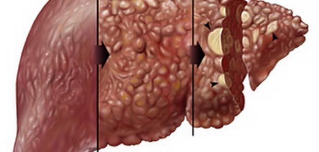اعراض التليف الكبدي , شاهد مايهلك الجسم بأكمله