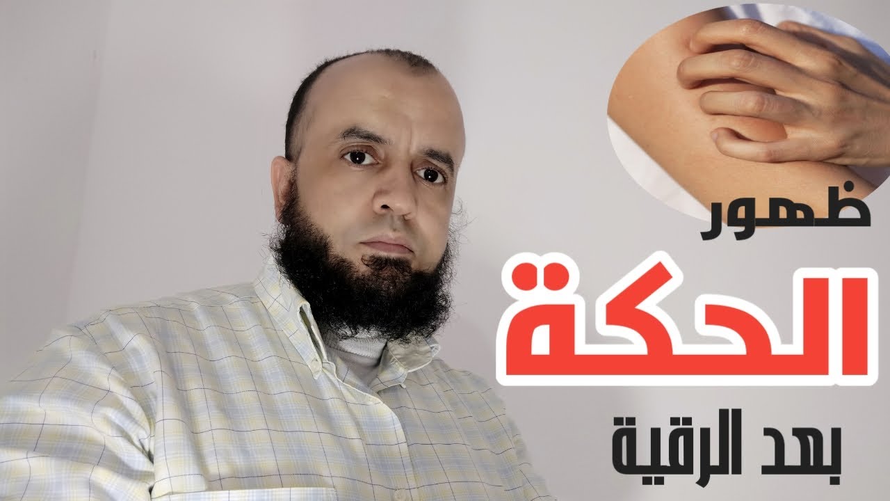 الحكه ذبحتني ريحوني الله يكتب لكم الراحه , لكل مريض ومجهد من الحكه