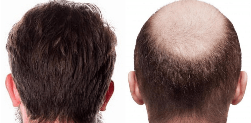 زراعة الشعر قبل وبعد , شعرك هيطلع حتى لو أصلع