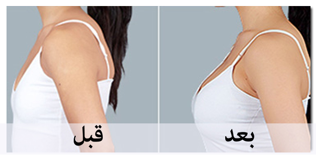 عمليات تجميل الثدي , طرق شد الثدى بالعمليات